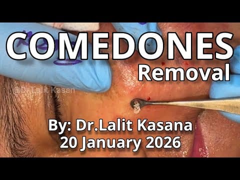Recent post by Dr. Lalit Kasana - Skin Treatment