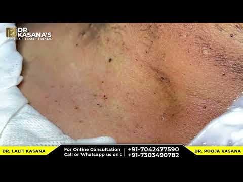 Recent post by Dr. Lalit Kasana - Skin Treatment
