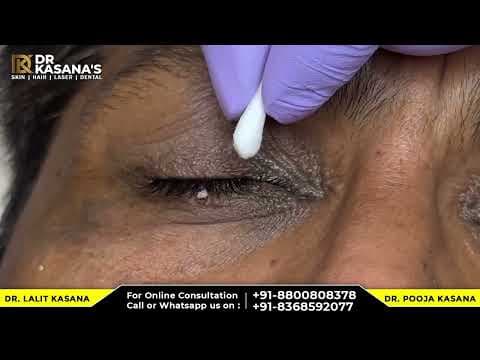 Recent post by Dr. Lalit Kasana - Skin Treatment