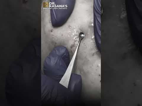 Recent post by Dr. Lalit Kasana - Skin Treatment