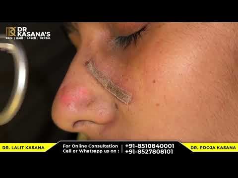 Recent post by Dr. Lalit Kasana - Skin Treatment