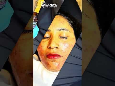Recent post by Dr. Lalit Kasana - Skin Treatment
