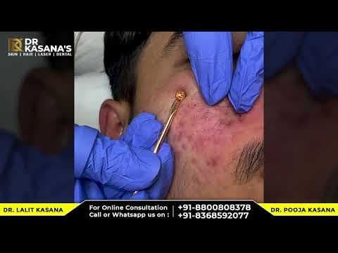 Recent post by Dr. Lalit Kasana - Skin Treatment