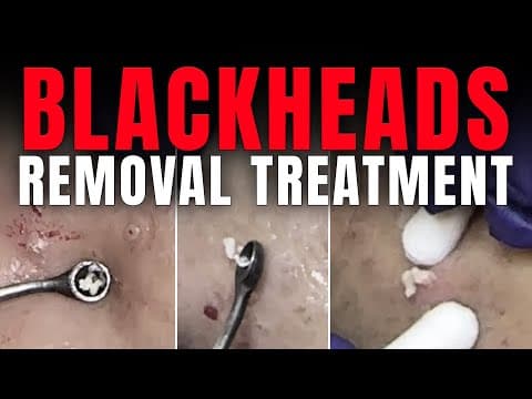 Recent post by Dr. Lalit Kasana - Skin Treatment