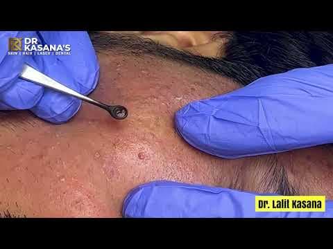 Recent post by Dr. Lalit Kasana - Skin Treatment