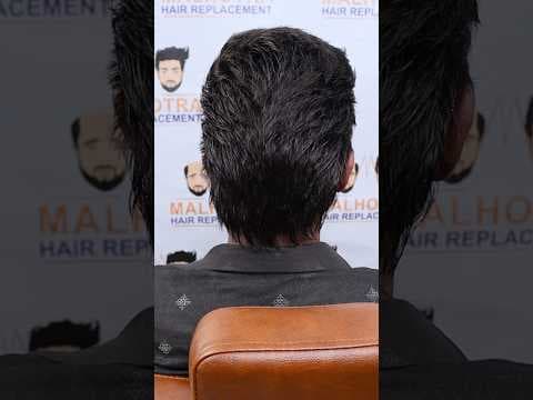 Recent post by Malhotra Hair Replacement