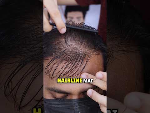 Recent post by Malhotra Hair Replacement
