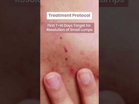 Recent post by SkinEva Clinic Dr. Sunil Kothiwala