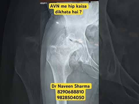 Recent post by Dr Naveen Sharma's knee and shoulder clinic
