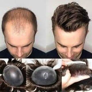 Hair Patch Ludhiana